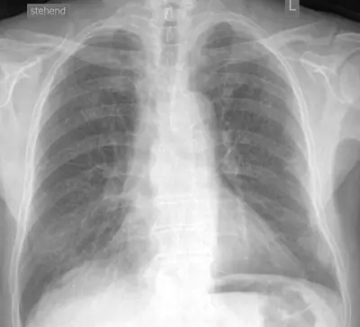 Radiograph from the case bank: Silicosis / pneumoconiosis