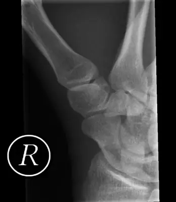Radiograph from the case bank: Scaphoid fracture