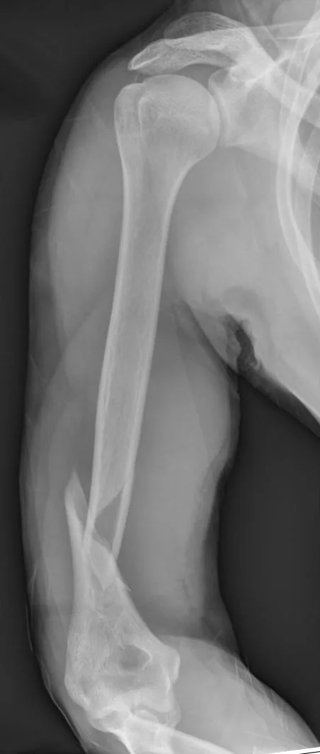 Upper limb radiograph for self-assessment