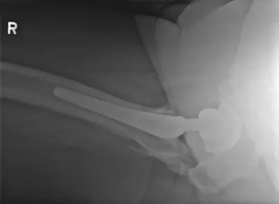 Radiograph from the case bank: Heterotopic ossification