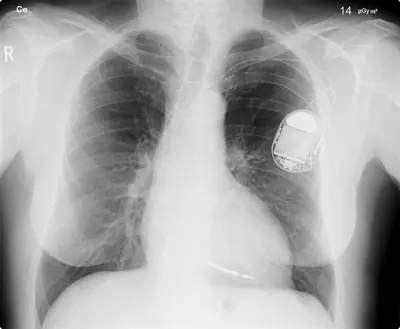 Radiograph from the case bank: Cardiac pacemaker