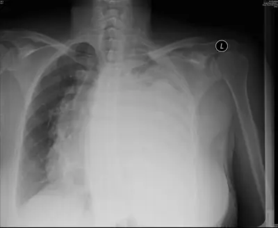 Radiograph from the case bank: Pleural effusion