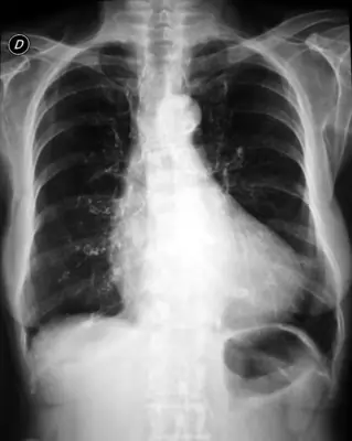 Radiograph from the case bank: Cardiomegaly