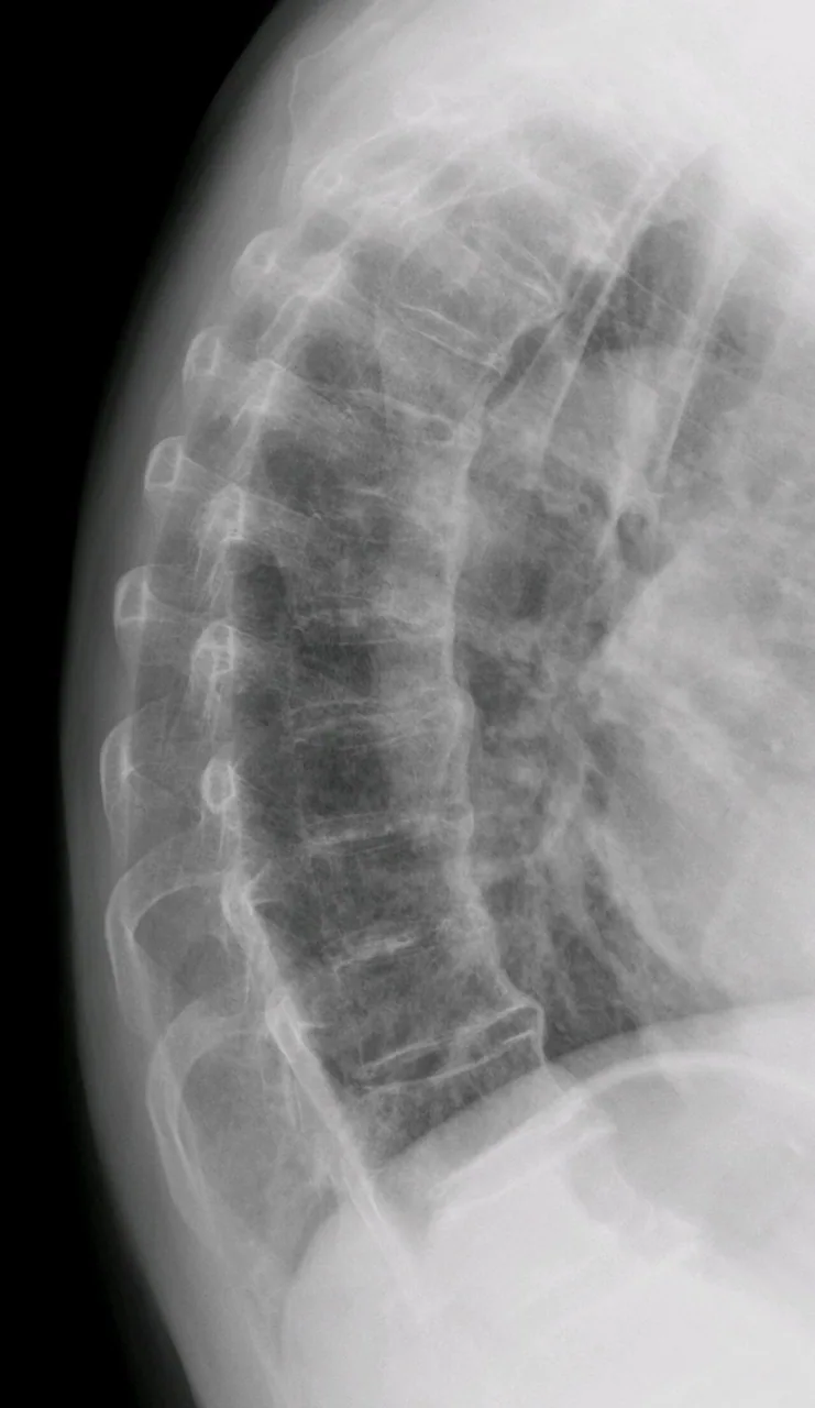 Spine radiograph for self-assessment