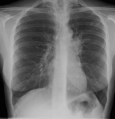 Radiograph from the case bank: Pulmonary tuberculosis