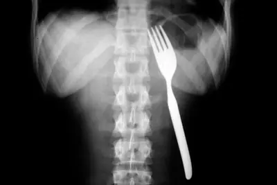Radiograph from the case bank: Foreign body (ingested or inserted)