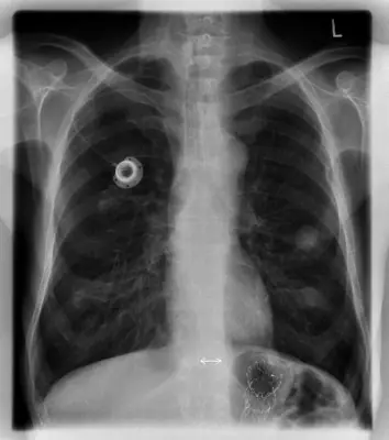 Radiograph from the case bank: Implanted venous access port (port-a-cath)