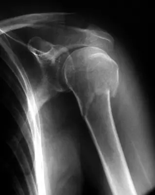 Radiograph from the case bank: Proximal humerus fracture