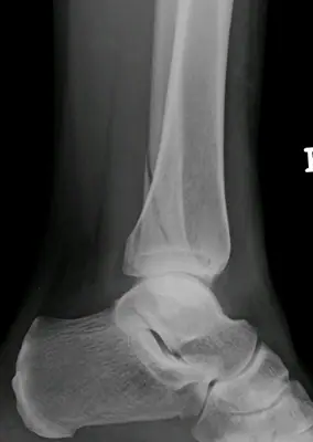 Radiograph from the case bank: Ankle fracture (lateral malleolus)