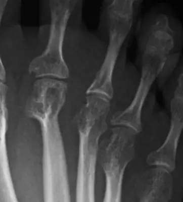Radiograph from the case bank: Rheumatoid arthritis