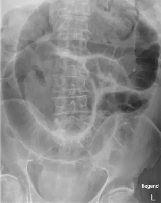 Radiograph from the case bank: Volvulus