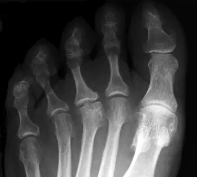 Radiograph from the case bank: Freiberg disease
