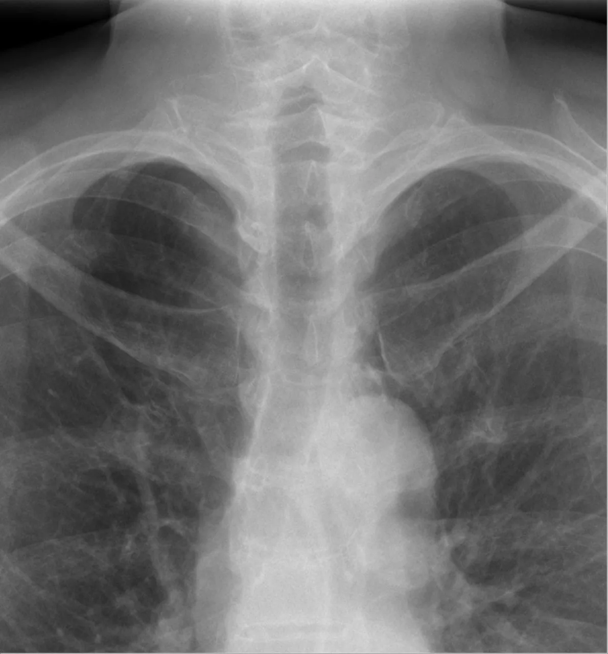 Chest radiograph for self-assessment