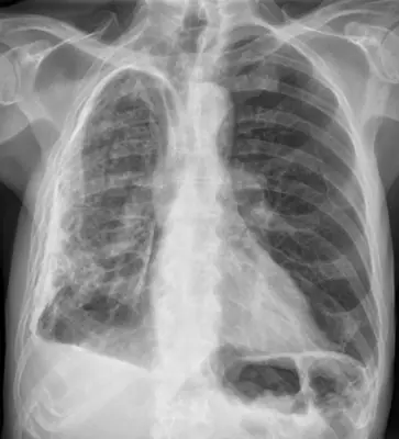 Radiograph from the case bank: Pulmonary tuberculosis