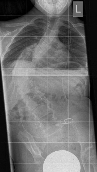 Spine radiograph for self-assessment