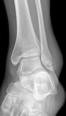 Radiograph from the case bank: Ankle fracture (lateral malleolus)
