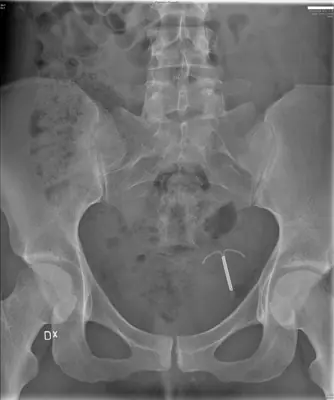 Radiograph from the case bank: Intrauterine contraceptive device (IUCD)
