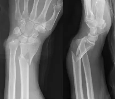 Radiograph from the case bank: Galeazzi fracture-dislocation