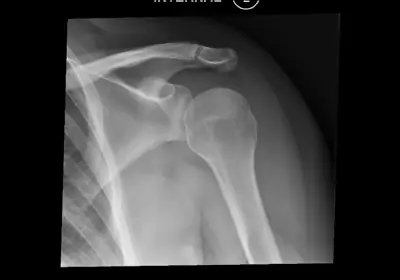 Radiograph from the case bank: Hill-Sachs lesion