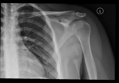 Radiograph from the case bank: Hill-Sachs lesion