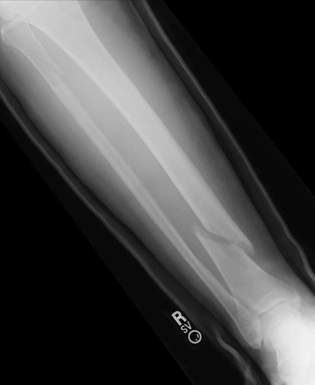 Lower limb radiograph for self-assessment