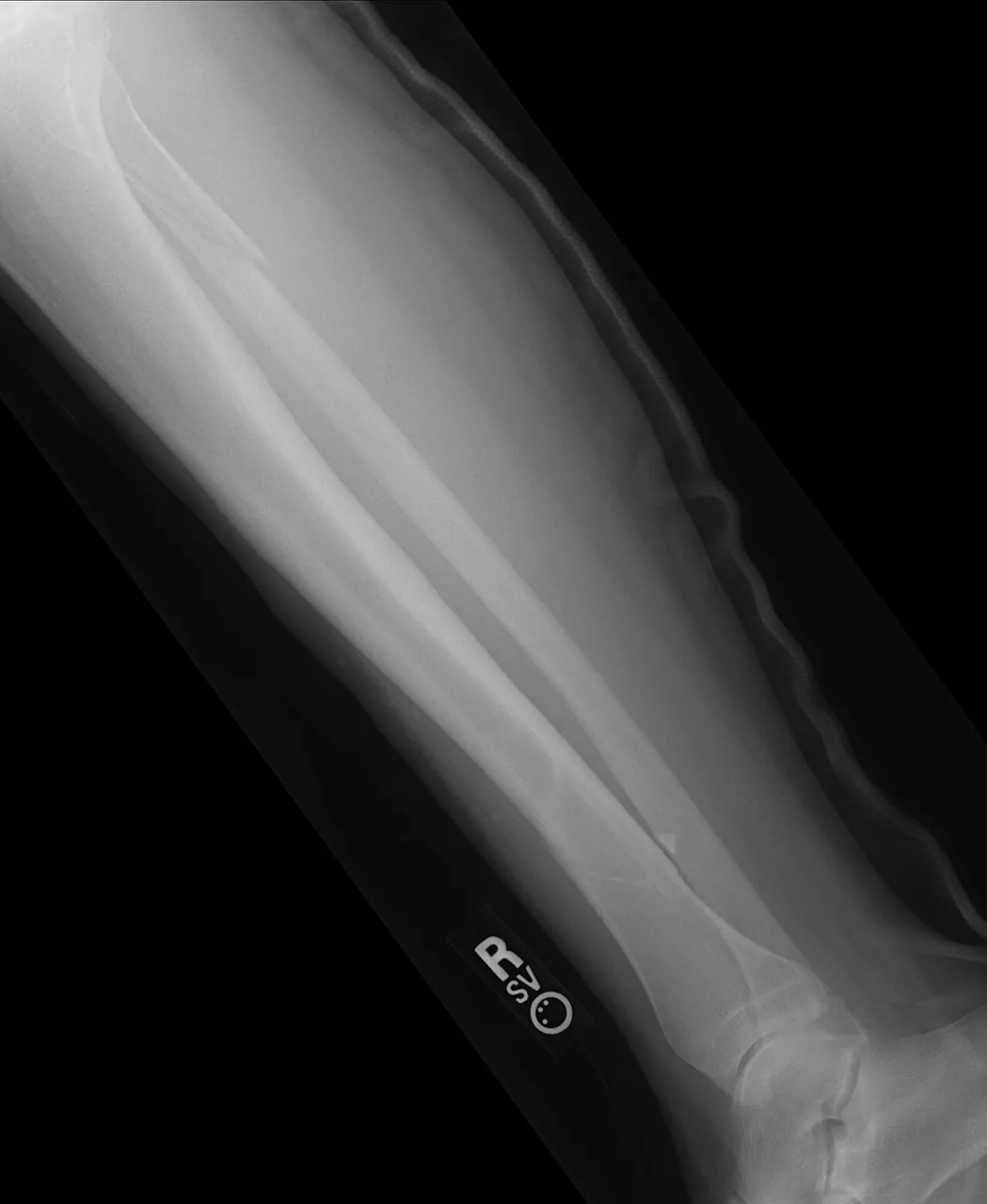 Lower limb radiograph for self-assessment