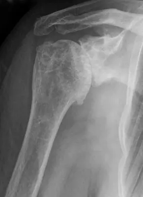 Radiograph from the case bank: Osteoarthritis