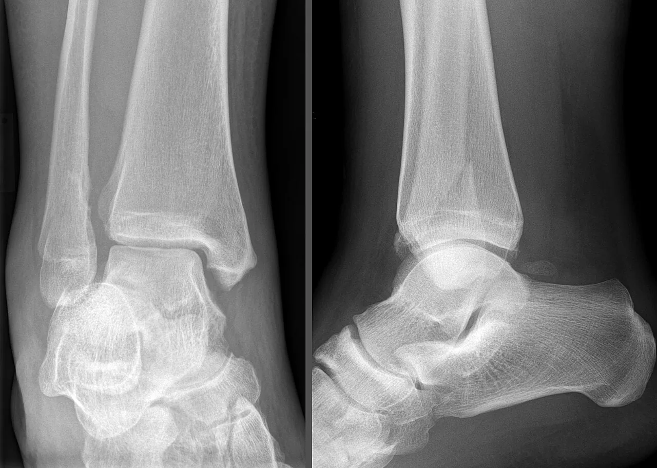 Lower limb radiograph for self-assessment