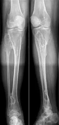 Radiograph from the case bank: Osteochondroma (exostosis)
