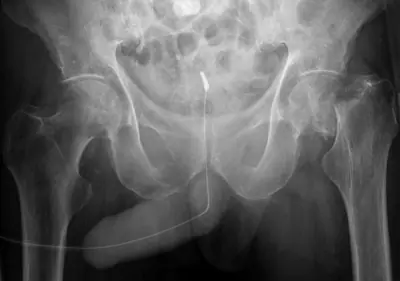 Radiograph from the case bank: Hip (proximal femoral) fracture