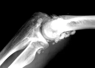 Radiograph from the case bank: Synovial chondromatosis
