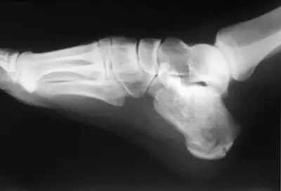 Radiograph from the case bank: Calcaneal fracture