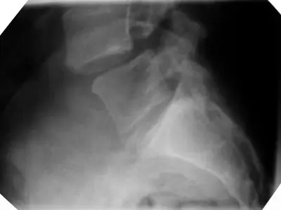 Radiograph from the case bank: Spondylolisthesis