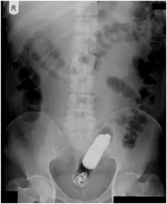 Radiograph from the case bank: Foreign body (ingested or inserted)