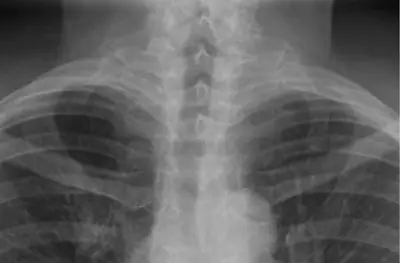 Radiograph from the case bank: Cervical rib