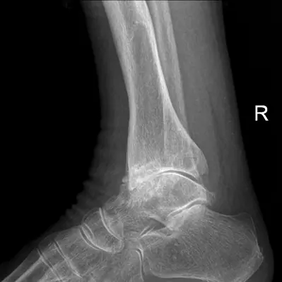 Radiograph from the case bank: Osteoarthritis