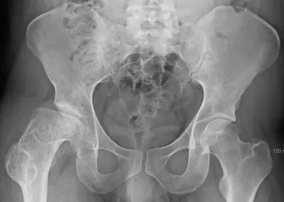 Radiograph from the case bank: Perthes disease