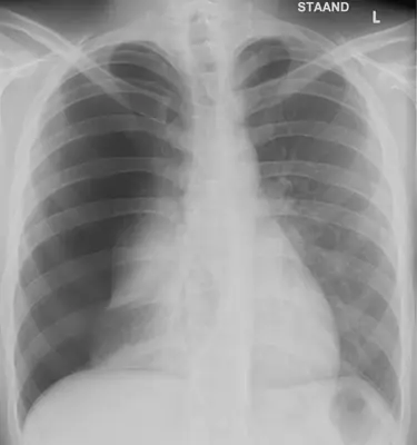 Radiograph from the case bank: Pneumothorax