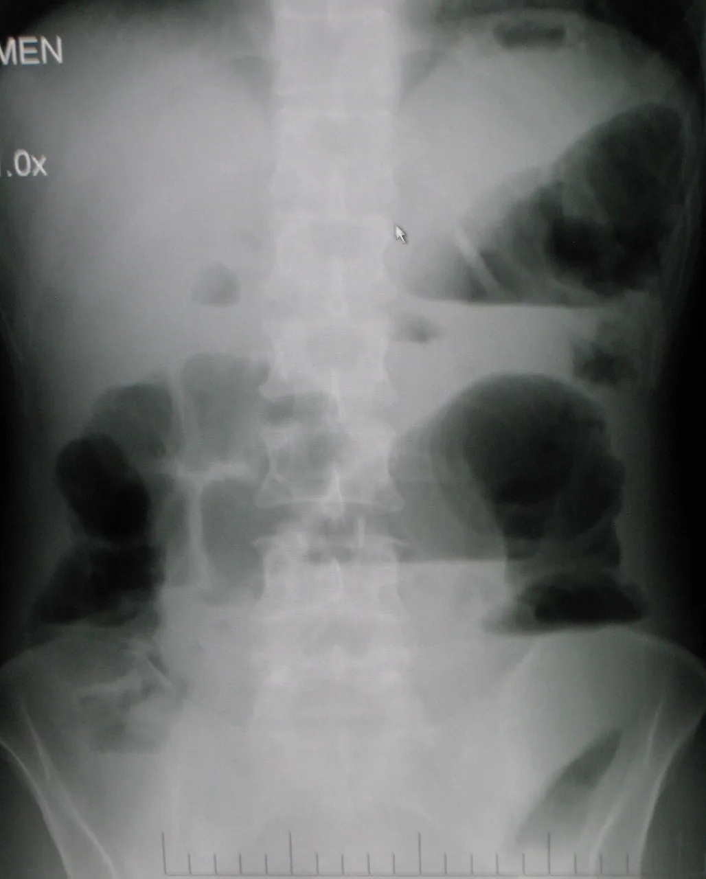 Abdomen radiograph for self-assessment