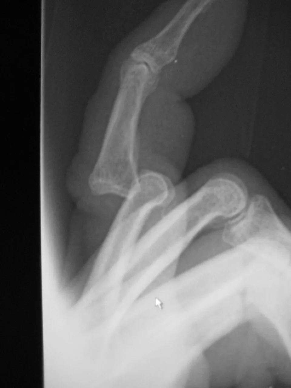 Upper limb radiograph for self-assessment