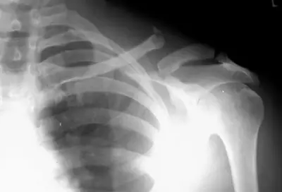 Radiograph from the case bank: Clavicle fracture