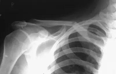 Radiograph from the case bank: Clavicle fracture