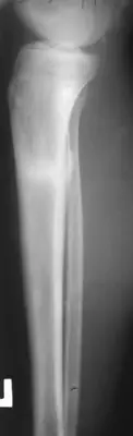 Radiograph from the case bank: Tibial (and fibular) shaft fracture