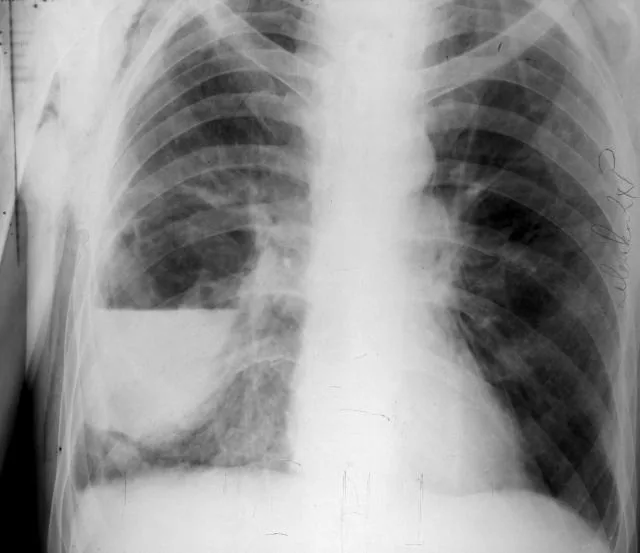 Chest radiograph for self-assessment