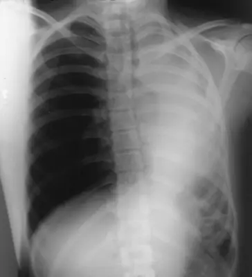 Radiograph from the case bank: Lung collapse (atelectasis)
