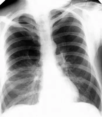 Radiograph from the case bank: Emphysema / COPD (hyperinflation)