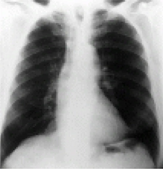 Chest radiograph for self-assessment