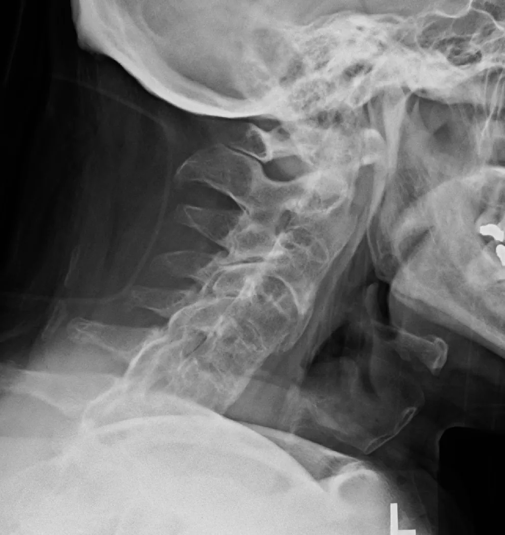 Spine radiograph for self-assessment