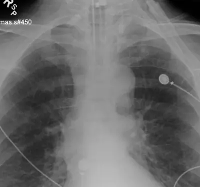 Radiograph from the case bank: Endotracheal tube