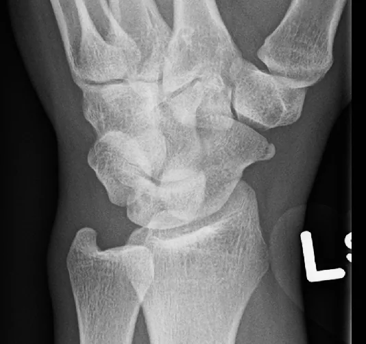 Upper limb radiograph for self-assessment